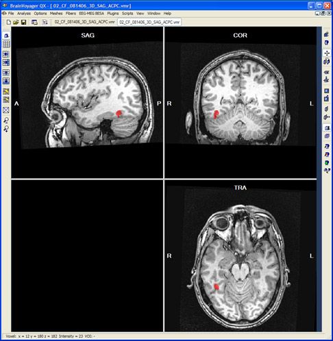Magnetic resonance image of a healthy subject from a functional imaging experiment, contrasting brain signal when viewing faces versus other objects: the red region is the 'Fusiform face area'.
