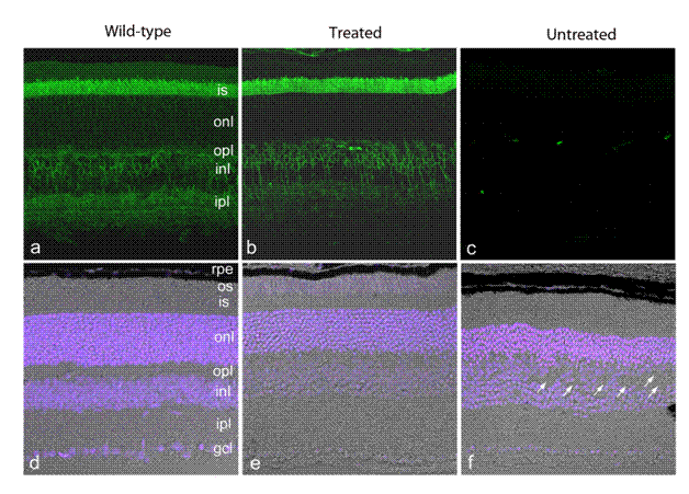Figure: Gene Therapy in a Mouse Model for X-linked Retinoschisis. Confocal scanning micrographs of retina tissue sections from a wild-type (left) and retinoschisin knockout (center and right) mouse. The right eye of retinoschisin knockout mouse was injected with adeno-associated vector (AAV) containing human retinoschisincDNA (treated); the left eye was not injected (untreated). Panels a-c. Retina sections labeled with an anti-retinoschisin antibody (green). Panels d-f.Same sections showing the DAPI nuclear stain (blue) together with DIC imaging. Treated retina of the retinoshisin knockout mouse looks remarkably similar to the wild-type retina with strong retinoschisin expression. Untreated retina shows holes in the retina and evidence of photoreceptor degeneration and no retinoschisin expression.